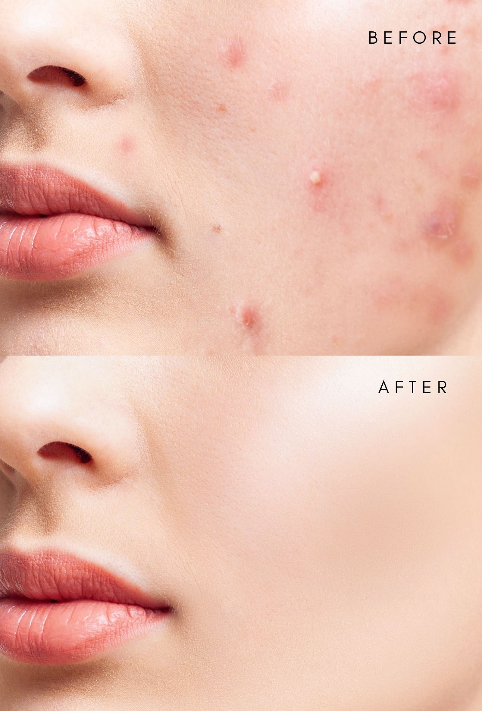 Acne Control Neem Face Pack