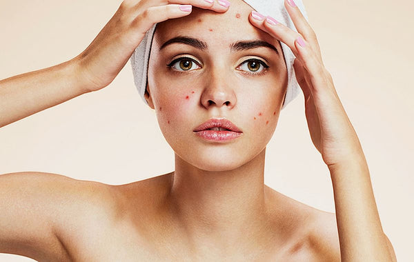 Acne Warrior
